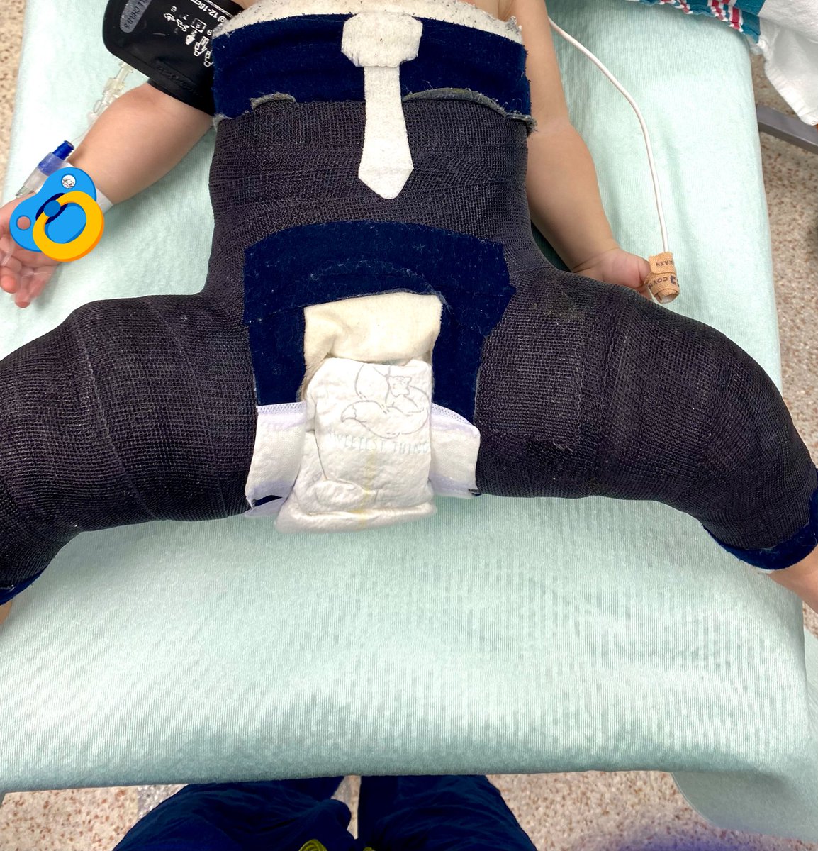 EyadAlakkas's tweet photo. Hip spica cast - post closed reduction of DDH for #boss_baby
جبيرة البنطلون لمريض يشتكي من خلع الورك التطوري الولادي
#cheo https://t.co/gEKiVOeqzz