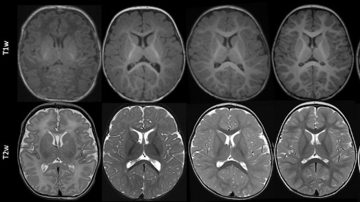 #DeepLearning ensemble model of brain MRIs precisely predicted brain myelin maturity of 710 infants and children buff.ly/3YdwyJM @Tugba_Akinci_MD @JakobWasserthal @UniSpitalBasel #PedsRad #AI #MachineLearning