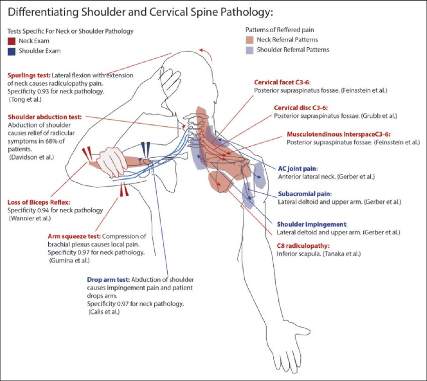 Omid_HopeUni's tweet photo. Pain referral patterns for the shoulder and examination to differentiate shoulder/neck pathology

#shoulder #neck #paint 

https://t.co/AzcJnizDdg https://t.co/Ka9r6CEphZ