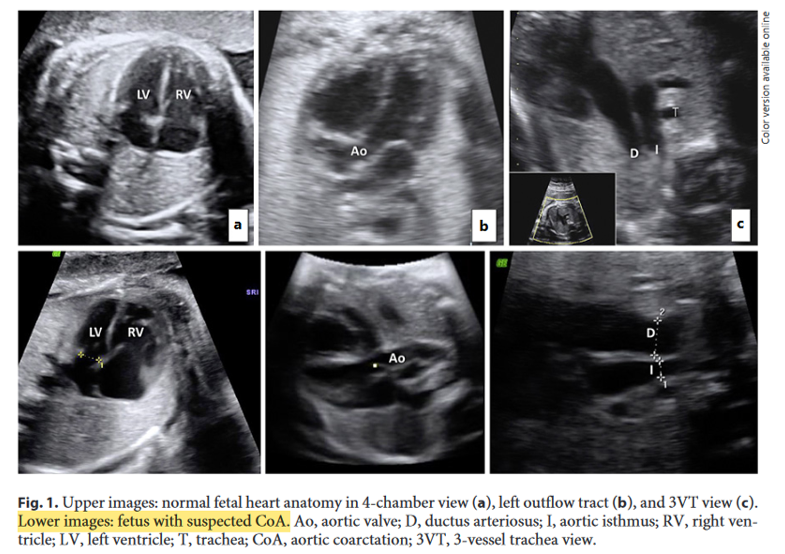 CardioCaribeMx's tweet photo. Diagnóstico prenatal coartación aórtica
Rel Istmo/ductus >0.74 Normal
Rel Istmo/ductus <0.60 Coartación
Entre 0.60-0.74 acorde a edad gestacional
<28 SDG relación VT/VM >1.5 predice CoAo
>28 SDG #valorz del istmo z-2 CoAo
DOI: 10.1159/000520449
#echofetal #3vt #prenatal https://t.co/ASvyFKgHZF
