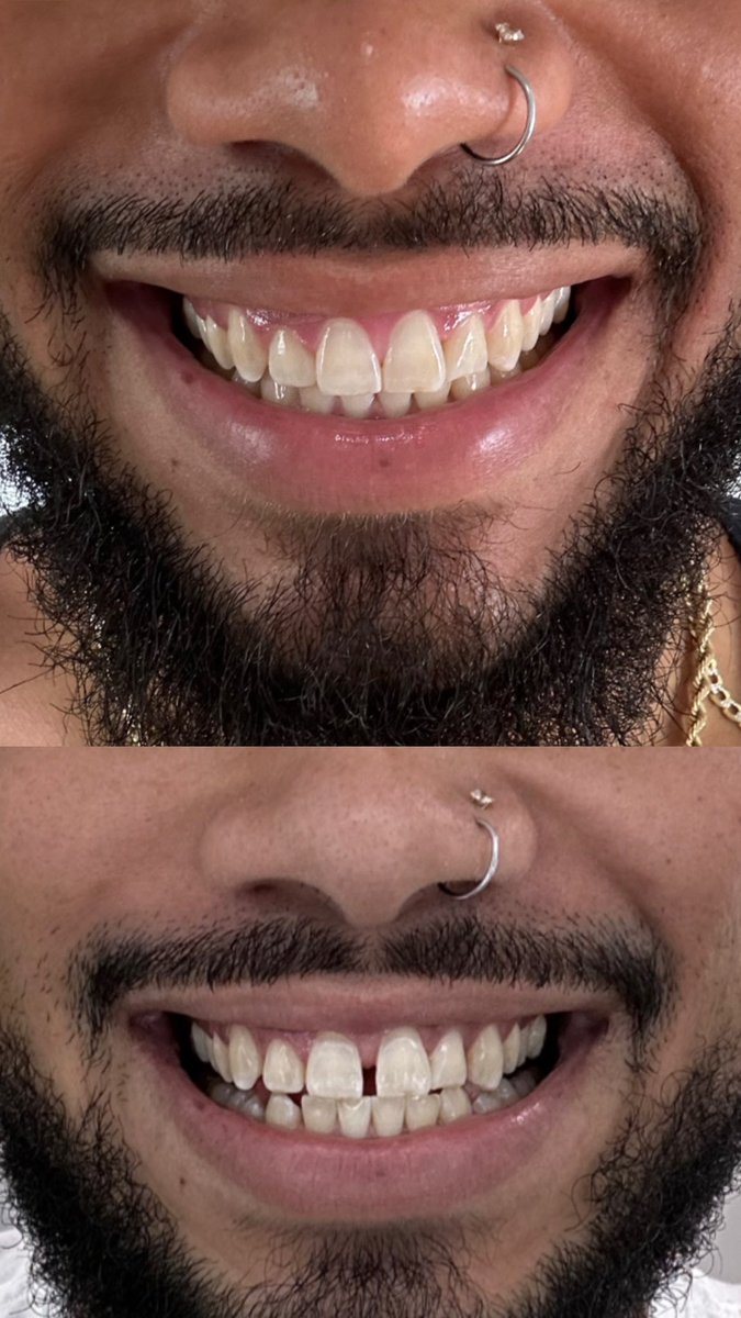 nOates_'s tweet photo. Best 2 Grand I ever spent @smiledirectclub … Today Vs Feb 15th 2023… https://t.co/M8hAmgNjB5