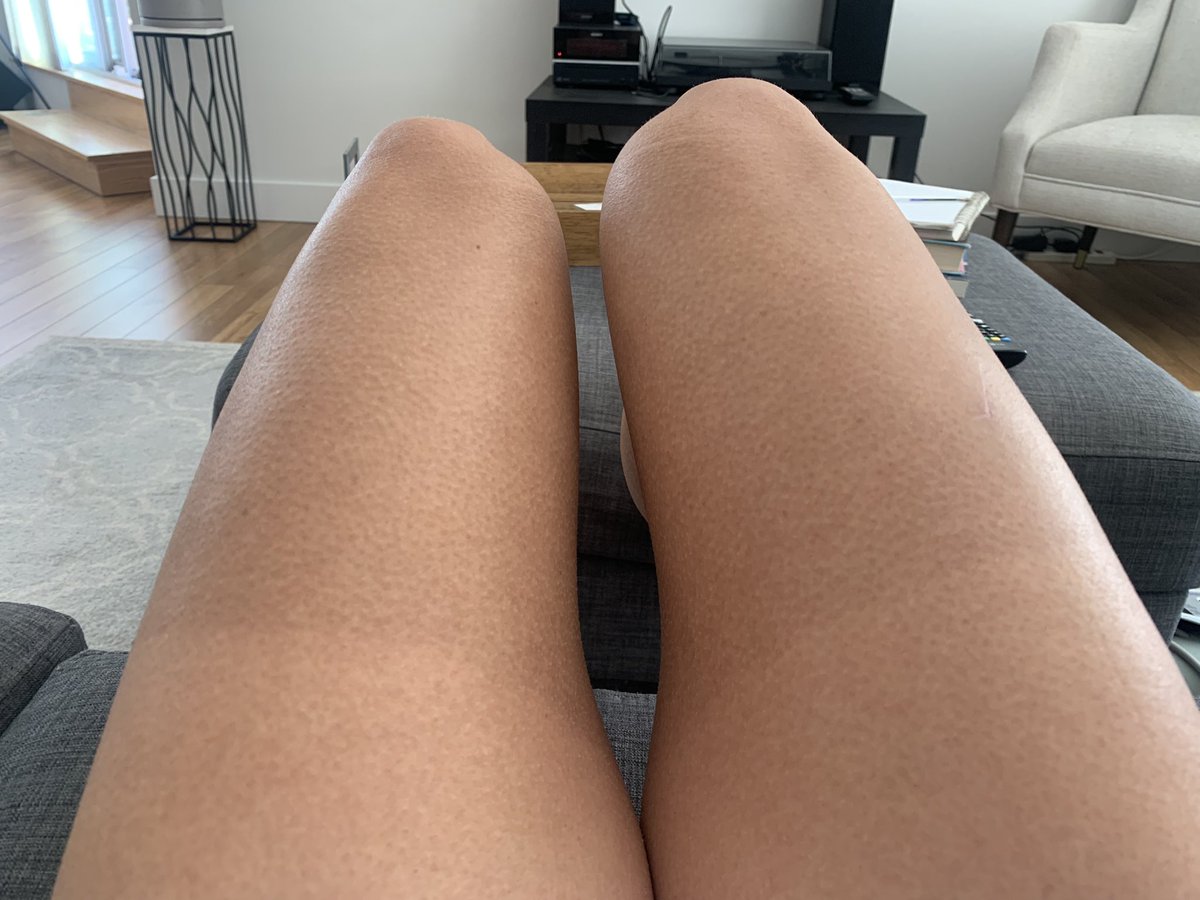 RachelDNurse's tweet photo. #LongRunProblems no sunscreen has ever been able to prevent this from happening so far #Running #tanlines 23 km today ☺️ https://t.co/D1gpvJG0xh