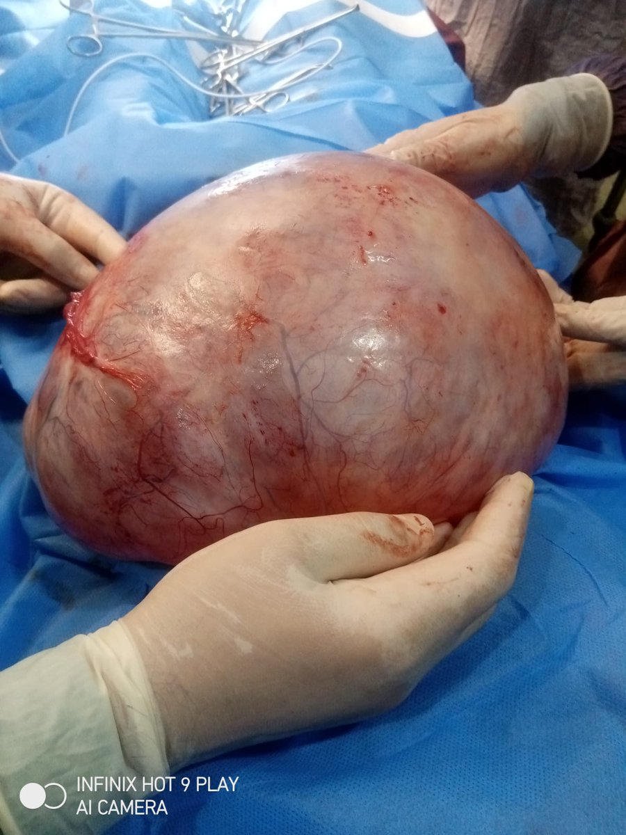 Baloch_Surgeon's tweet photo. Huge ovarian cyst of around 10kg is removed successfully
#Surgery 
#Surgeons 
@Surgeon_Baloch https://t.co/99IXouUC1l