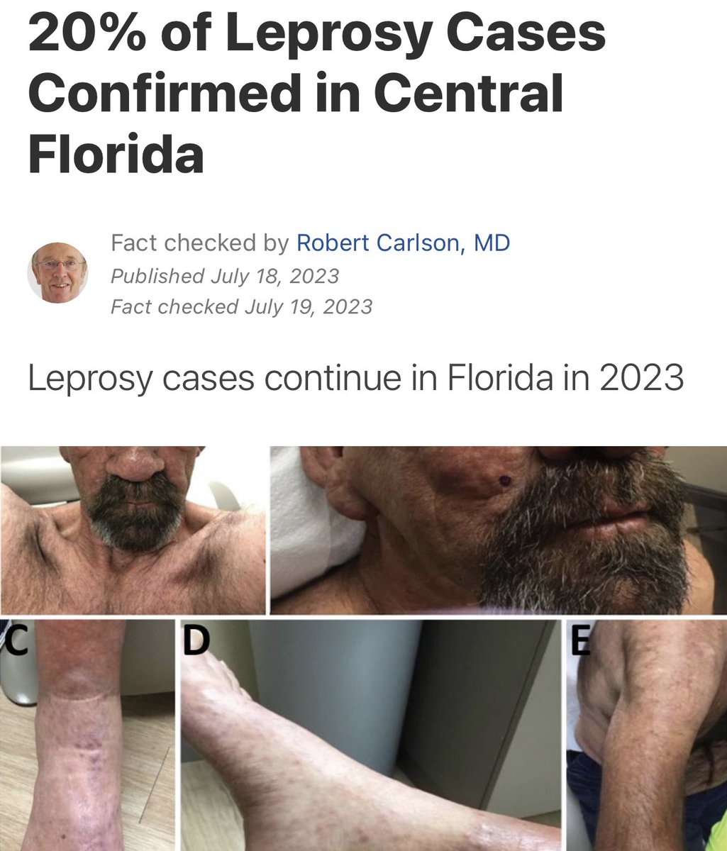 MeidasTouch's tweet photo. Rising evidence shows that leprosy may now be endemic in Florida. 

Central Florida alone accounts for nearly 20% of the total number of cases reported in the United States. https://t.co/z62g21poWJ