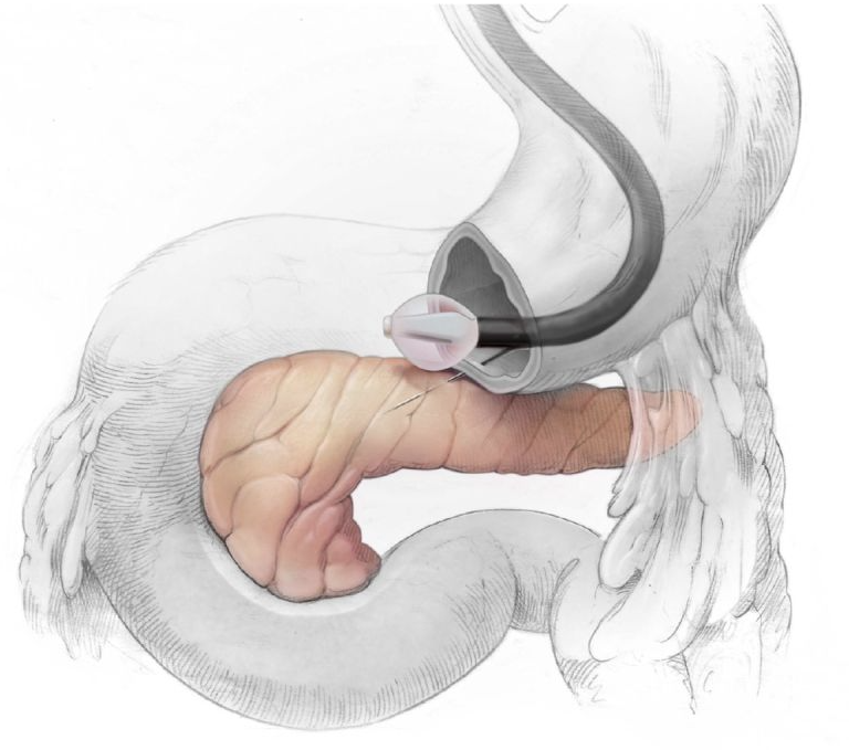 発想が凄い！！！
 
｢根本的な糖尿病治療の可能性｣
 
･ Revita: FDA breakthrough device
･ 上部内視鏡を用いて十二指腸に挿入したバルーンを拡張し、粘膜層に生食注入、バルーンの熱水でアブレーションで正常な組織の再生を誘導
･ 7人の治験でHbA1cが1.6%低下

businesswire.com/news/home/2023…