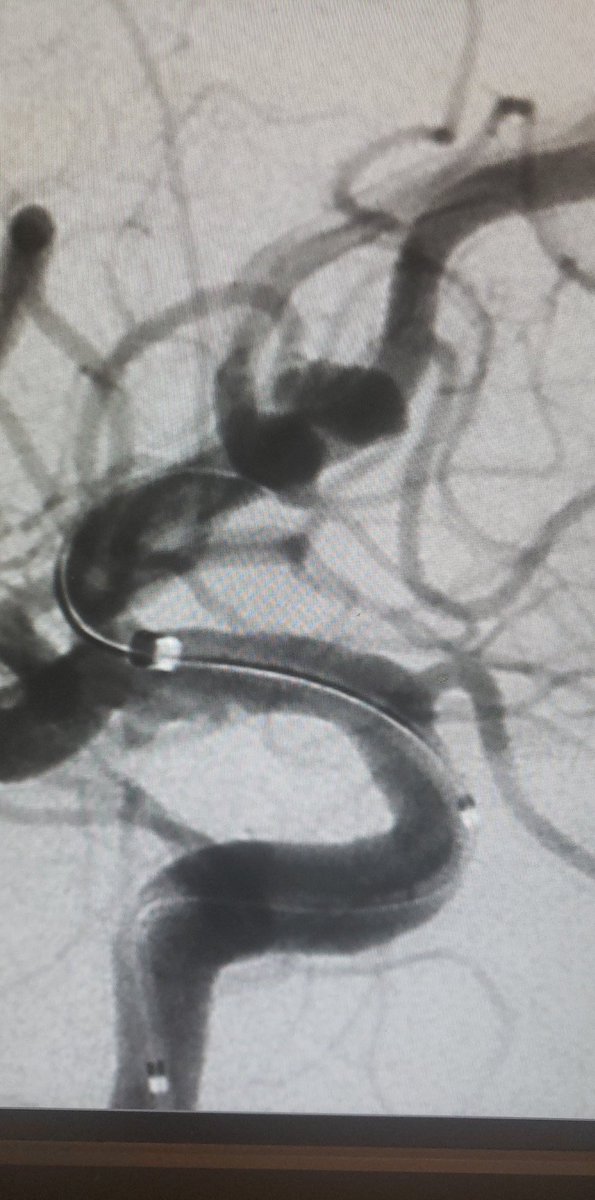 DennysReyesMD's tweet photo. Framing and finishing a 4mm Ruptured Acom aneurysm with Target Tetra coils @Stryker_NV @DelrayMedCenter with @JeanFra73758031 
#palmbeach #stroke #health #brain #headache #EMS #Emergency #fitness #Neurology #aneurysm #cerebral #coils https://t.co/Ya41jgaoW1