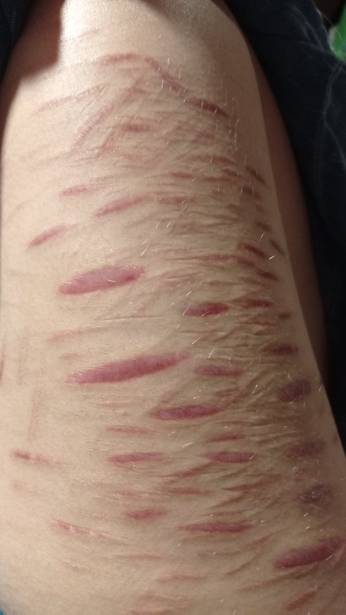 ly_eiih's tweet photo. i rll love my scars 😸 https://t.co/S0PfXPCvuE