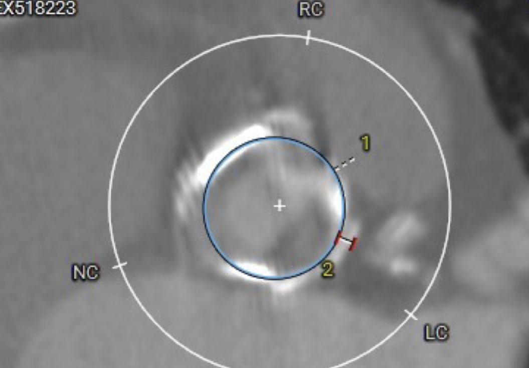 Ahmed Almomani (@drmomani) on Twitter photo 19 Mitroflow (ture ID 15.5) with severe AS mild to moderate AI, very narrow sinuses and very low LM suppling proximal LAD/Diag and OM 1, atretic LIMA to distal LAD, RCA ostial CTO with patent graft. Not a surgical candidate. <a href="/UTHealthSAValve/">UT Health San Antonio Valve Center</a> 19 Mitroflow (ture ID 15.5) with severe AS mild to moderate AI, very narrow sinuses and very low LM suppling proximal LAD/Diag and OM 1, atretic LIMA to distal LAD, RCA ostial CTO with patent graft. Not a surgical candidate. <a href="/UTHealthSAValve/">UT Health San Antonio Valve Center</a>