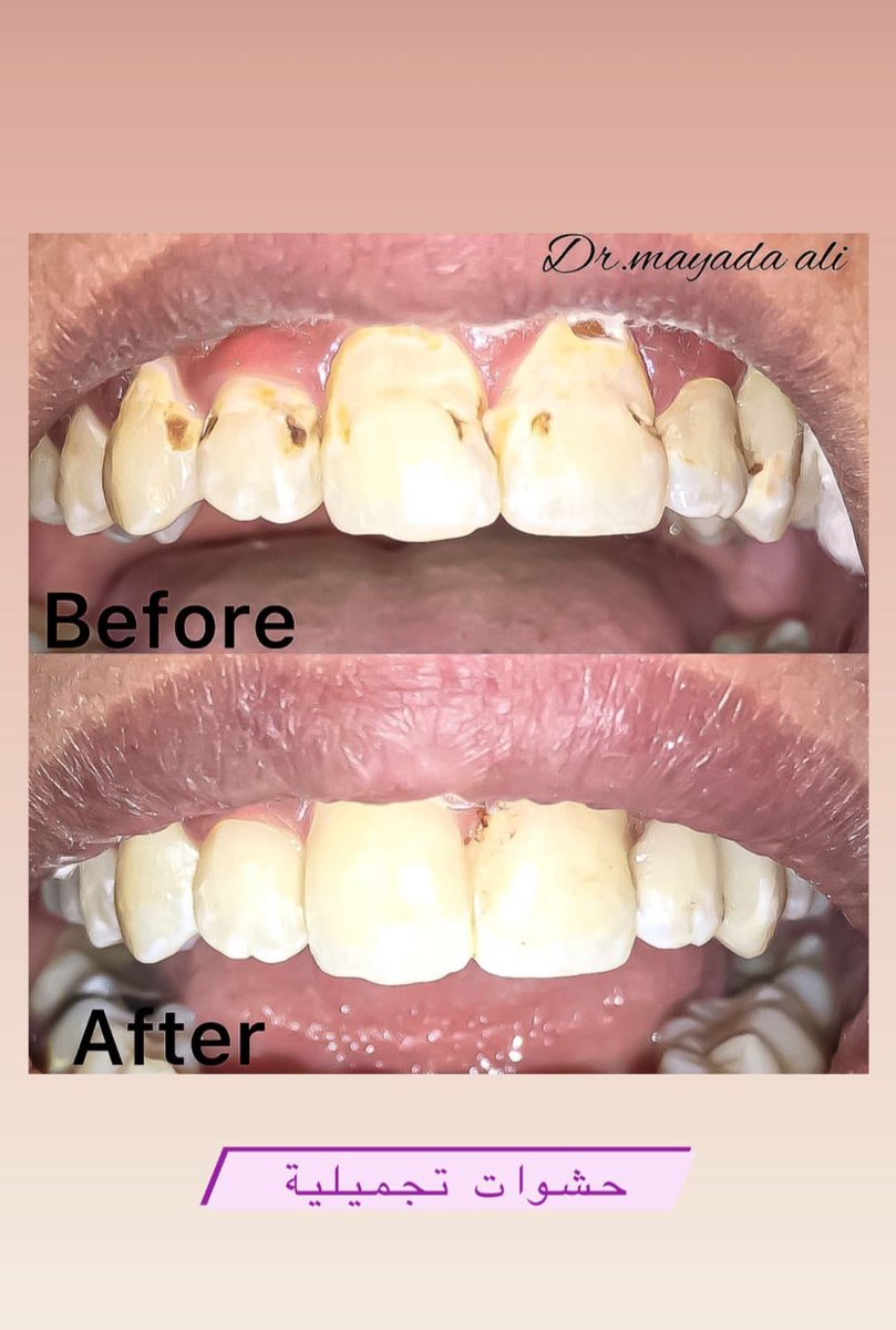 #الكلاسيكو #ريال_مدريد_برشلونه #يوم_الصداقه_العالمي #عيادة_أسنان #عروض #المزاحميه #ضرما_المزاحمية #عيادات_تجميل #تبييض_اسنان #باقات #الدفع #تمارا #تابي