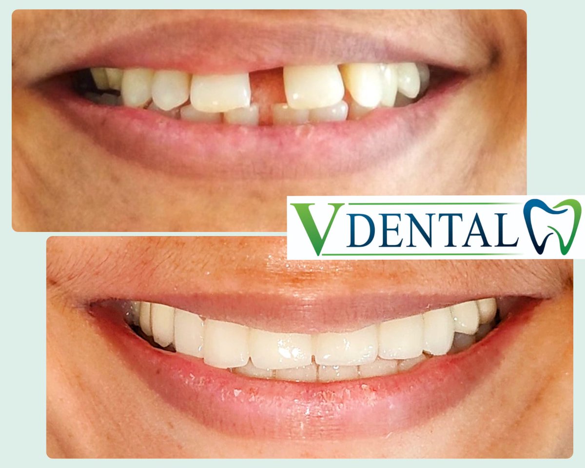 VDentalCare's tweet image. Cosmetic Treatment &amp;amp; Smile Designing Treatment at "V Dental Hospital" Srikakulam Branch.All Types of Dental Treatments are Available.
Address: Krishna Park Jn, Srikakulam. Cell: 6305270891.,V Dental Hospital #cosmetics #smiledesign #fixedteeth #basalimplants #EHS #implantsurgery