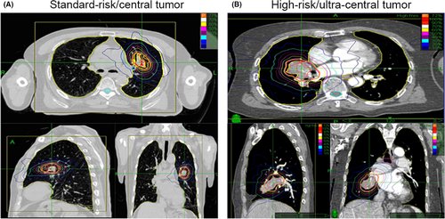 FuenteApolo's tweet photo. The concept of risk adaptation with optimized PTV is increasingly insisted on, and it is logical in these locations.
SBRT #lcsm central, ultracentral  #radonc 
1
https://t.co/ElxJFkKysp ART ETHOS
2
https://t.co/i9pqfgVEgq ART RMlinac.

3 Cyberknife https://t.co/SxEnInUgcG https://t.co/Jc6YlYGKKA