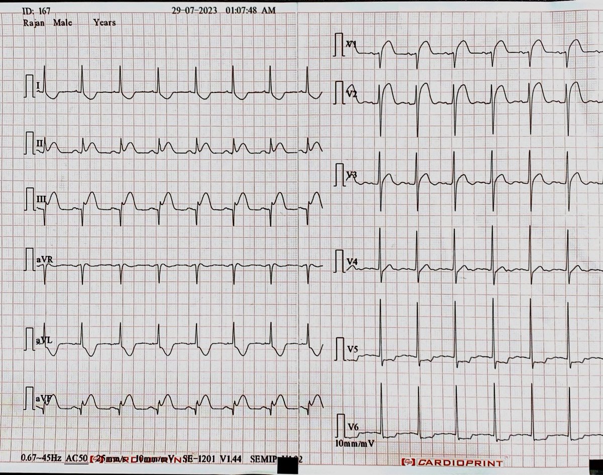 DrRajeshG1's tweet photo. Which is/are the infarct related artery/arteries and the site of occlusion? https://t.co/YGnVgEQ9dM