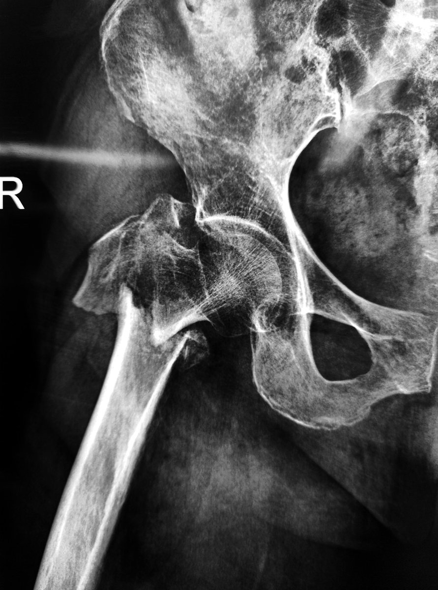 OrthoJianWANG's tweet photo. #Hipreplacement for intertrochanteric fractures, femoral stem + titanium cable, equivalent to strong #internalfixation
#MedTwitter #orthotwitter https://t.co/1PgJpNwICR