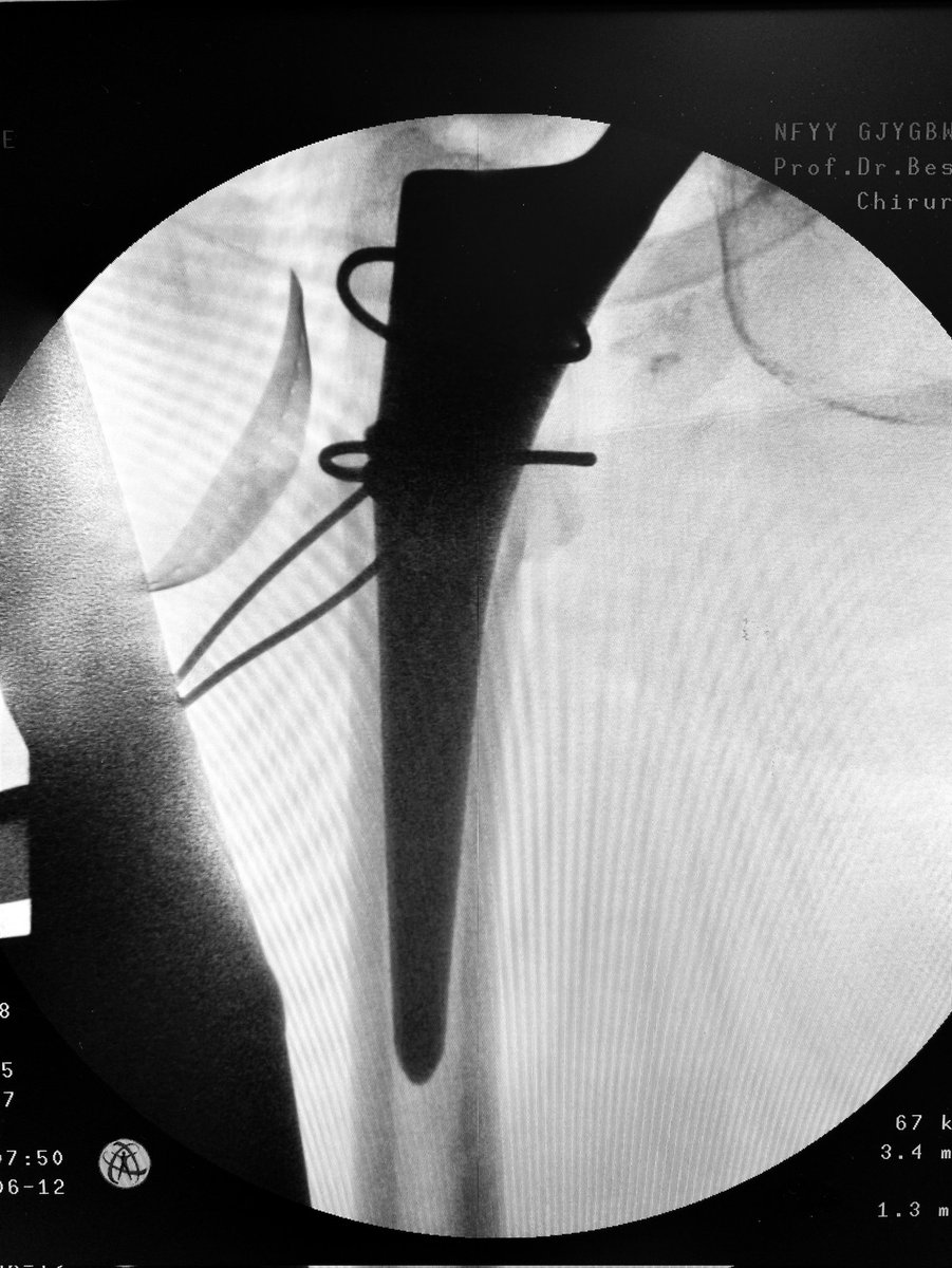 OrthoJianWANG's tweet photo. #Hipreplacement for intertrochanteric fractures, femoral stem + titanium cable, equivalent to strong #internalfixation
#MedTwitter #orthotwitter https://t.co/1PgJpNwICR