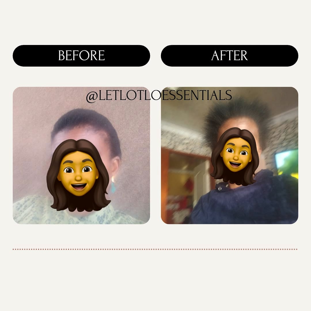 Before and after Pic
Results after a month of using <a href="/LetlotloEssen/">Letlotlo Essentials</a> herb infused hair growth oil
#hairoilsforgrowth #naturalingredients #naturalhair #handcrafted #smallbusinessowner  #ShakaiLembe #JuliusMalema