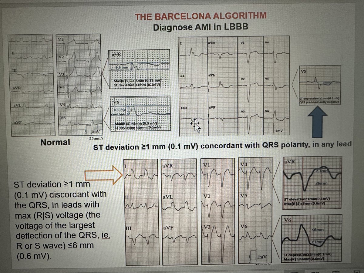 Sensitivity (36%) of the Sgarbossa criteria for AMI diagnosis in LBBB has been improved with Smith (91%) ST/S ratio &lt;_-0.25 to now Barcelona (93-95%) with just 2 criteria. Just remember 1.concordant ST dev in any lead or 2. Discordant ST dev&gt;1 mm in low voltage leads (R/S&lt;6mm)