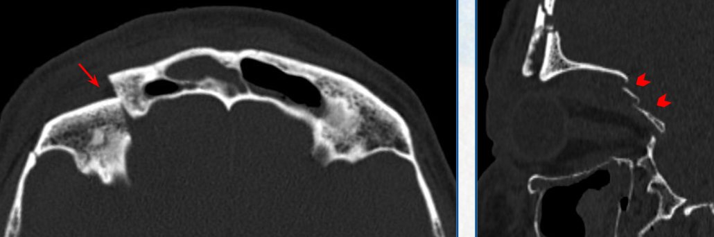 SERAM_RX's tweet photo. Urgencias traumáticas en cabeza y cuello: revisión pictórica 

🔎 Este #PiperSERAM revisa el amplio espectro de lesiones traumáticas en cabeza y cuello, así como los distintos mecanismos lesionales y los hallazgos en las pruebas de imagen 

Accede aquí 🔗 https://t.co/5MuR1lXBGN https://t.co/sycq7TK1ev