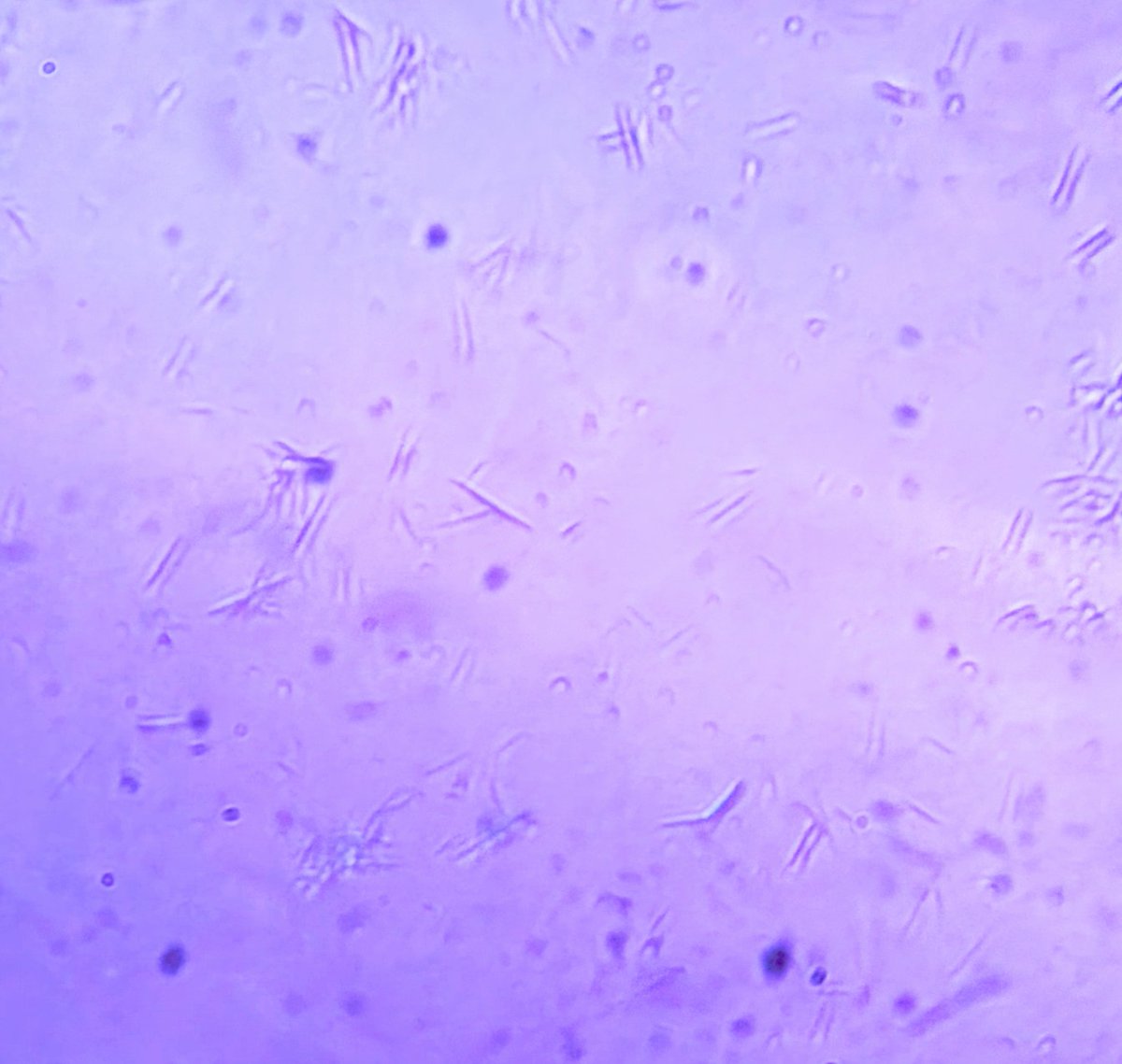ma6va's tweet photo. En fait, il ne s'en plaignait pas mais genou aussi gonflé, plus facile à ponctionner
Et satisfaction de faire le diagnostic en live 😃 #gout https://t.co/KxKHTake6P