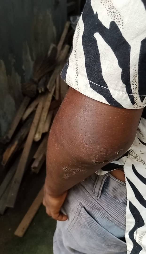 Ijawphilosopher's tweet image. His swollen arm. An eye witness reached out to us about it. Said she recently moved into the environment and observed the steady beatings.
she managed to take pictures today because the aunt went to church.

The boy says he doesn't want to live with her anymore.