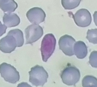 The following photos show gametocyte containing RBCs amongst other RBCs.