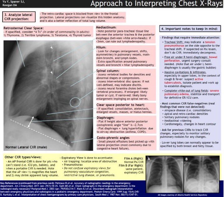 DrPharmDMDTh's tweet photo. Chest X-Ray Interpretation https://t.co/YrNMDBYoPA