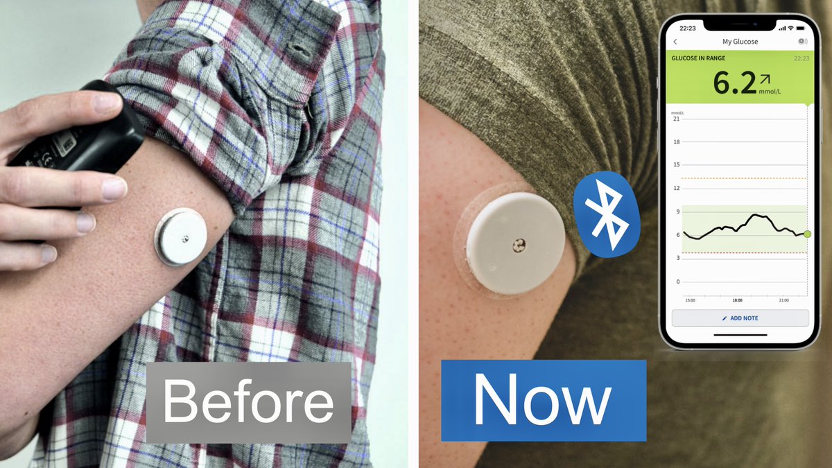 Massive update to Libre 2- new video. Freestyle Libre 2 works just like Dexcom now with real-time information and no scanning. In my new video, I am sharing how this works and how to update your Librelink app. Enjoy, Twitter.... sorrry X youtu.be/-u8tcHtN9kI