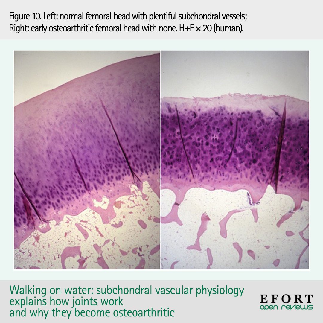EFORTnet's tweet image. Understanding subchondral #vascular physiology will be key to better #MRI classification and prevention, control, prognosis and treatment of #osteoarthritis and other #bonediseases 📄 bit.ly/43uubDg #histology #boneperfusion #OpenReviews #orthopedics #orthotwitter
