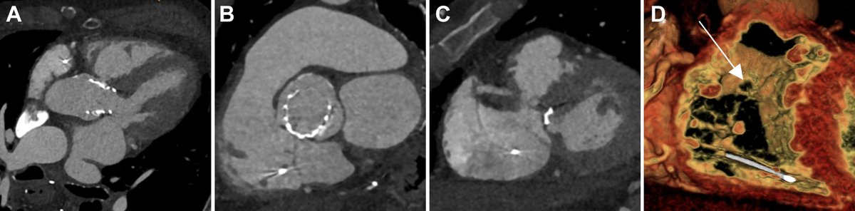 JACCJournals's tweet photo. See how multi-modality imaging can be used to guide percutaneous closure of an aorta-RV fistula following #TAVR in #JACCCaseReports: https://t.co/vvfQnc7bLV

#CRT2023 #CardioTwitter #yesCCT @cameron_dowling @CHaeffele_MD @drrahulpsharma @StanCVFellows https://t.co/fQXMB8P9RF