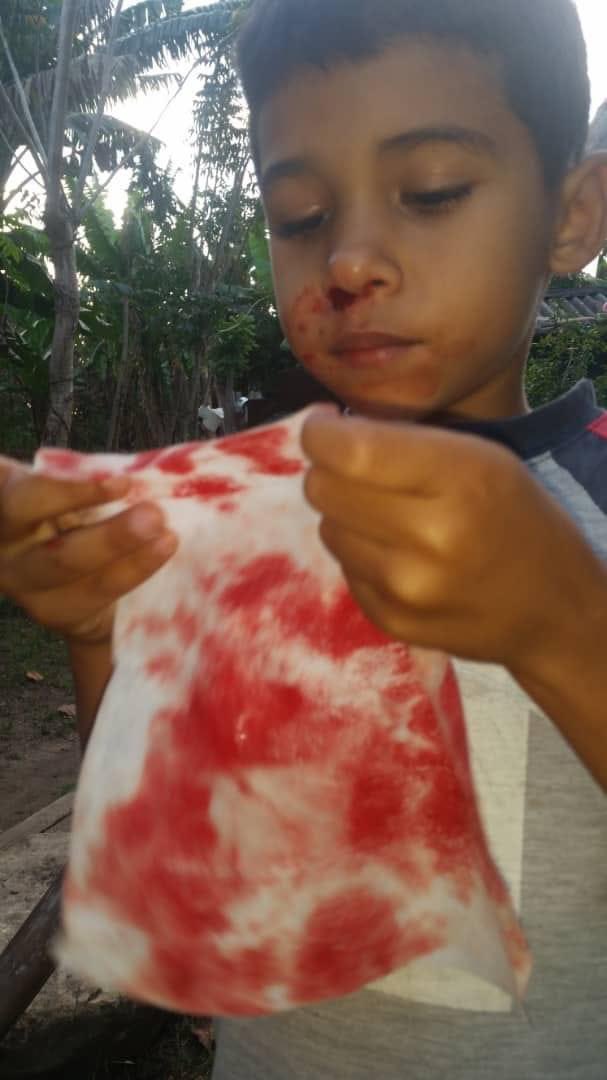 MesaYanko's tweet photo. ¡Urgente! Erick Yadiel se llama este príncipe. Tiene 7 años. Es de la provincia de Cienfuegos. Es un niño Hemofílico,trastorno de coagulación.Tiene una Trombrocitopenia. Epistaxis.Los medicamentos que necesita son Ácido Tranexámico conocido como Amchafibrin,también Fumarato Ferroso ,Ácido Fólico , Meclizine y Difenhidramina. Es un niño que por esa enfermedad no sube de peso. En nombre de su mamá pedimos Ayuda Humanitaria. Adjunto foto de uno de los medicamentos. Compartamos este post para ayudar a encontrar lo que necesita. El número de su mamá es +5354283883.