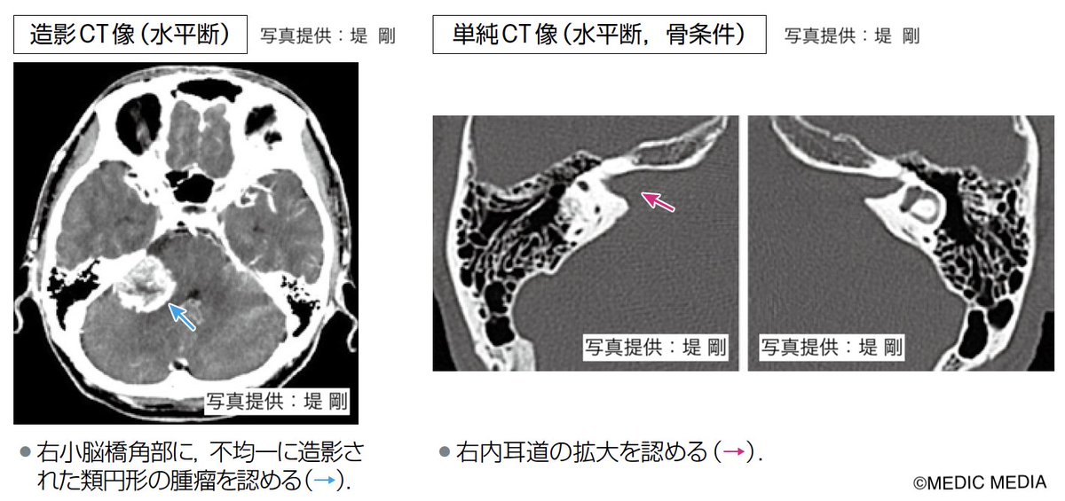 聴神経腫瘍のCT像】CTで内耳道の拡大や小脳橋角部に低～等吸収域の腫瘤