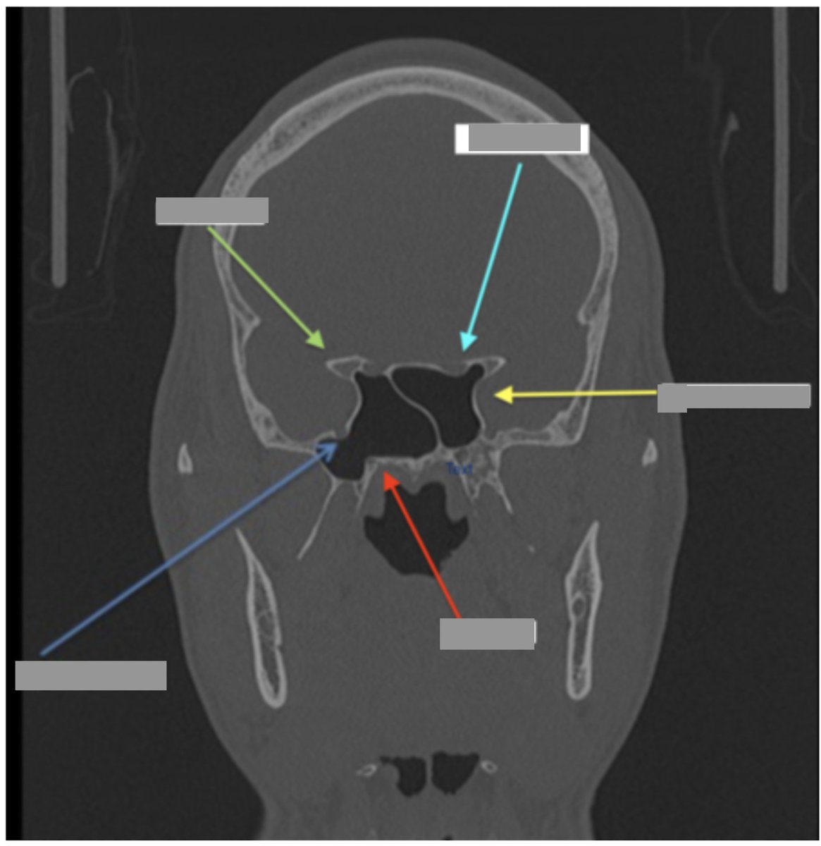 Sunday Review! Can you name the following landmarks shown by the arrows on this non-contrast sinus CT (coronal view)? --Retweet/share and I'll post answer later!
#headnecksurgery #medtwitter #radiology #sinussurgery #surgery #otohns #rhinology #skullbasesurgery #neurosurgery