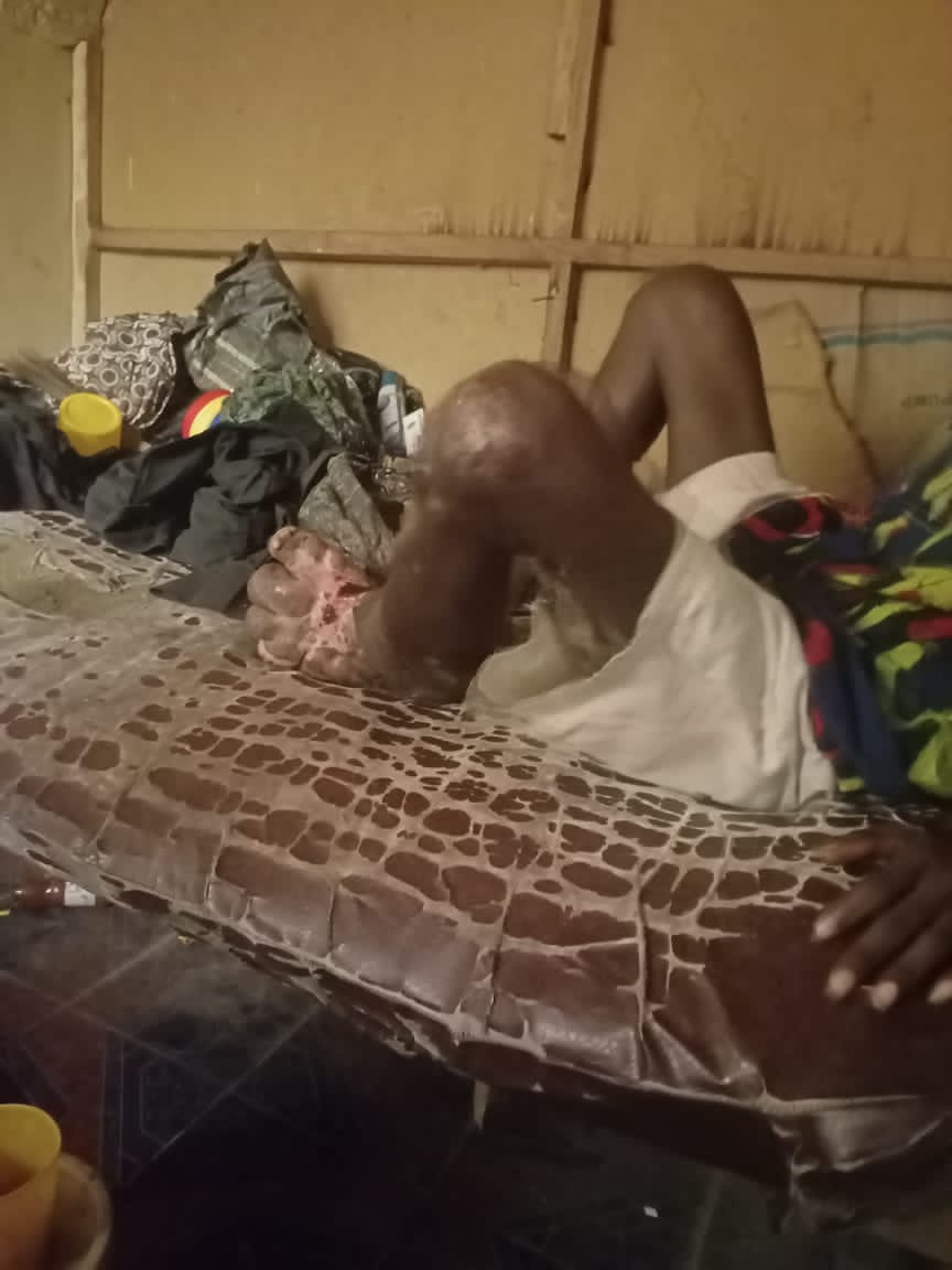 Bojbam's tweet photo. This is a friend (Badmus Adewumi Taiwo) base in Ibadan, family have try their best but now he is left alone to face his situation. 

The leg started swelling when we were in our final year 2016/2017, https://t.co/jdvUixANpK