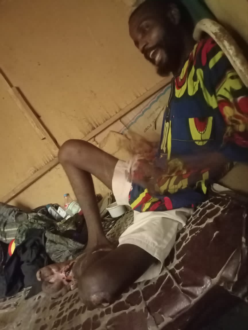 Bojbam's tweet photo. This is a friend (Badmus Adewumi Taiwo) base in Ibadan, family have try their best but now he is left alone to face his situation. 

The leg started swelling when we were in our final year 2016/2017, https://t.co/jdvUixANpK