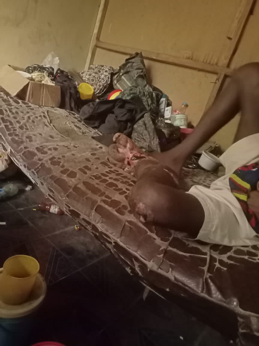 Bojbam's tweet photo. This is a friend (Badmus Adewumi Taiwo) base in Ibadan, family have try their best but now he is left alone to face his situation. 

The leg started swelling when we were in our final year 2016/2017, https://t.co/jdvUixANpK