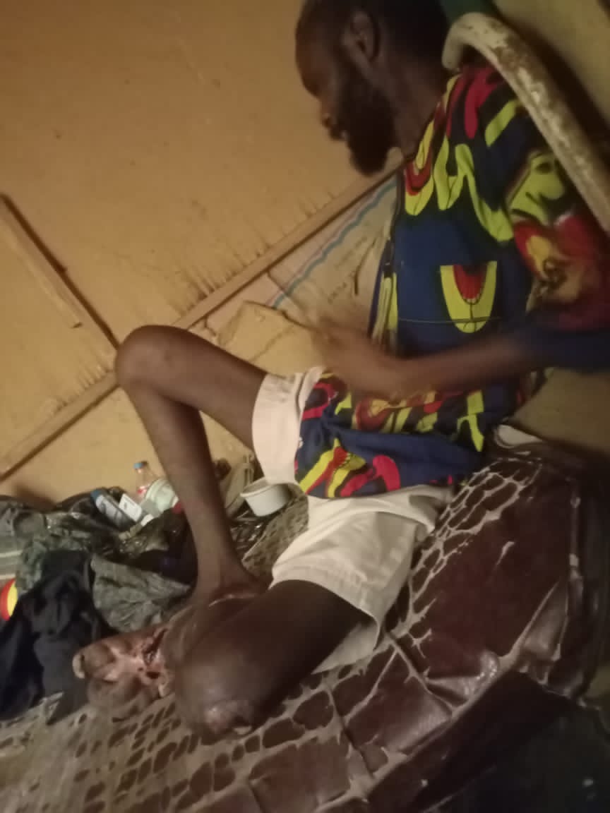 This is a friend (Badmus Adewumi Taiwo) base in Ibadan, family have try their best but now he is left alone to face his situation. 

The leg started swelling when we were in our final year 2016/2017,