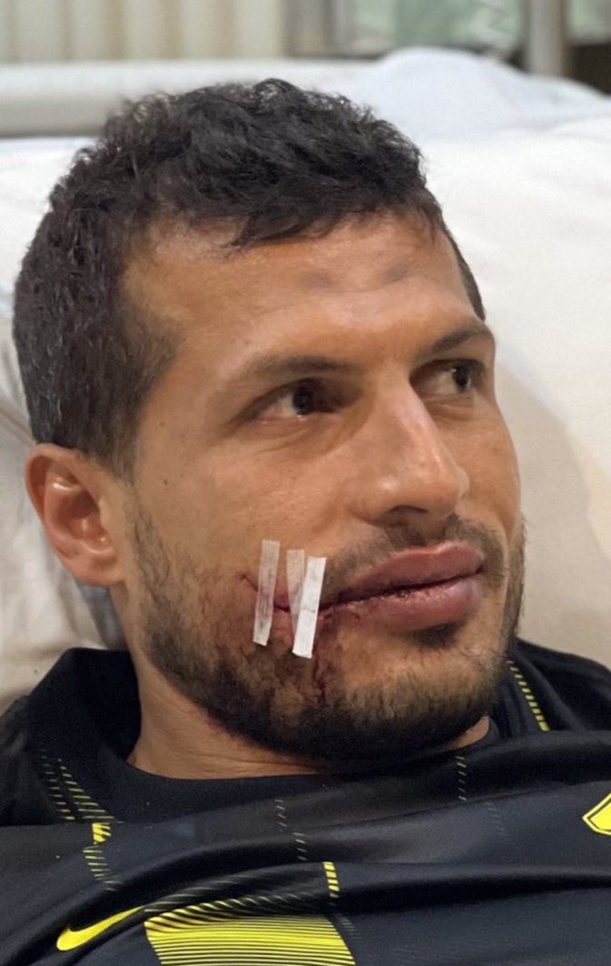 هذه جريمة كروية من لاعب الصفاقسي ويجب ان يشطب ويغرم 

ماذا لو ذهبت للعين او الفم 
الف سلامه عليك كأبتن طارق حامد