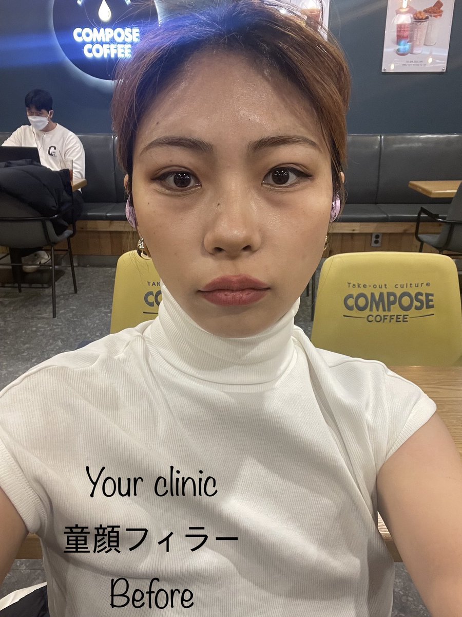 YOURCLINICJP's tweet photo. #スキンケア も #ユアクリニック #yourclinic 8月

#ピコ トーニング 無条件1.9万₩
#しわボト1箇所3900₩(限定)
#ポテンツァ 顔全体9.9万₩ (一人用チップ代3.9万₩~別)
#インモードFx顔全体5.9万₩(#明洞, #禾谷)
#ほくろ取り 1+1 2個 9900₩(#明洞, #禾谷)

リツイートしておくと,8月以降も適用可能 https://t.co/NzRcuCkY5n