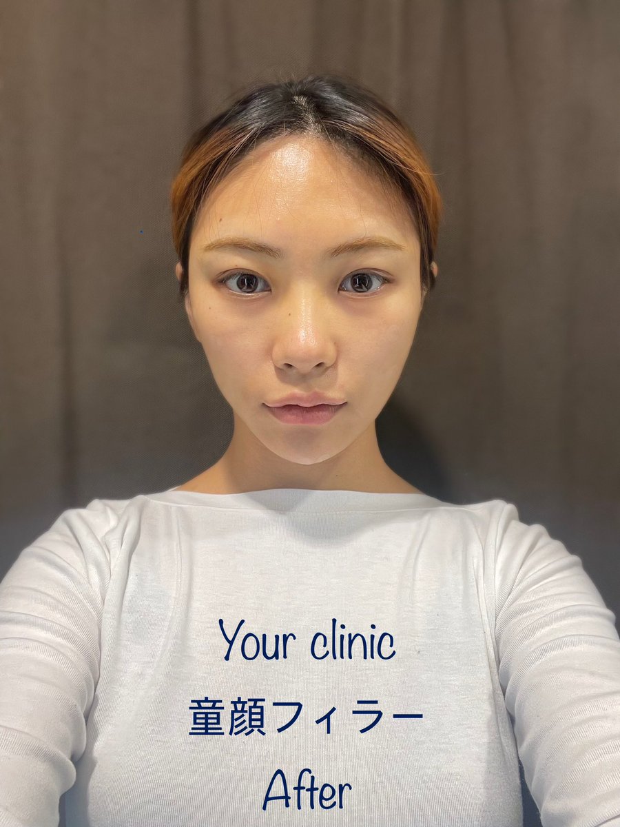 YOURCLINICJP's tweet photo. #スキンケア も #ユアクリニック #yourclinic 8月

#ピコ トーニング 無条件1.9万₩
#しわボト1箇所3900₩(限定)
#ポテンツァ 顔全体9.9万₩ (一人用チップ代3.9万₩~別)
#インモードFx顔全体5.9万₩(#明洞, #禾谷)
#ほくろ取り 1+1 2個 9900₩(#明洞, #禾谷)

リツイートしておくと,8月以降も適用可能 https://t.co/NzRcuCkY5n