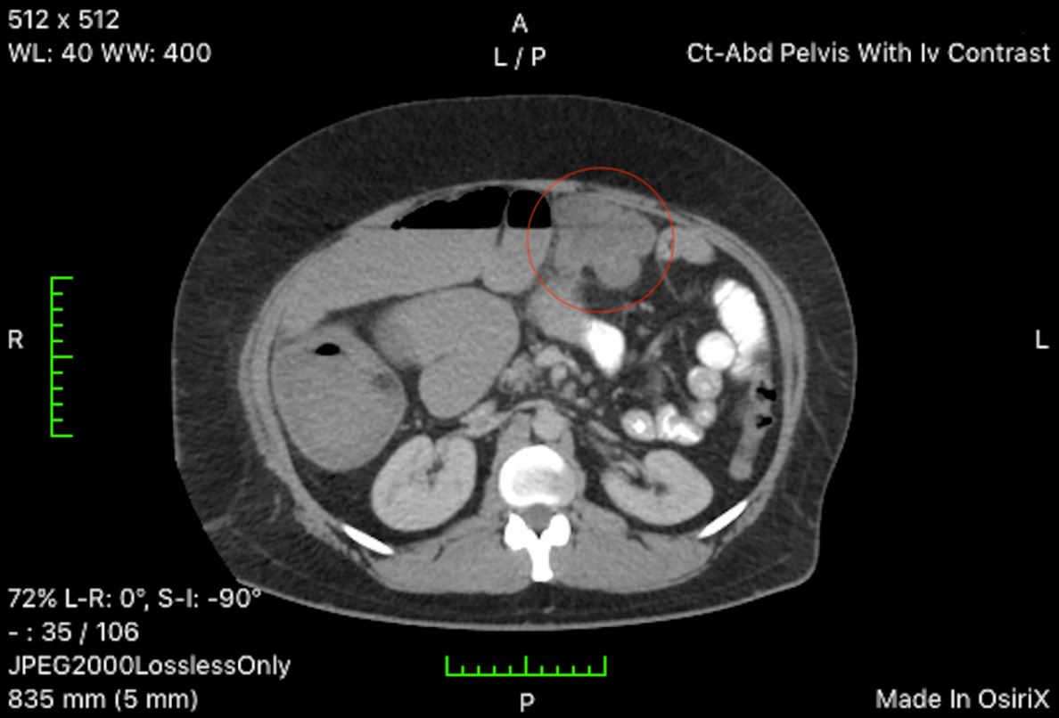 ACOSurgeons's tweet photo. Just published on the ACOS on Cureus General Surgery Channel: Obstructing Stage IV Adenocarcinoma of the Transverse Colon in a Young Patient With Vitiligo. Read and rate this article today! https://t.co/JhbWEluZOg https://t.co/ksrnFbsdOu