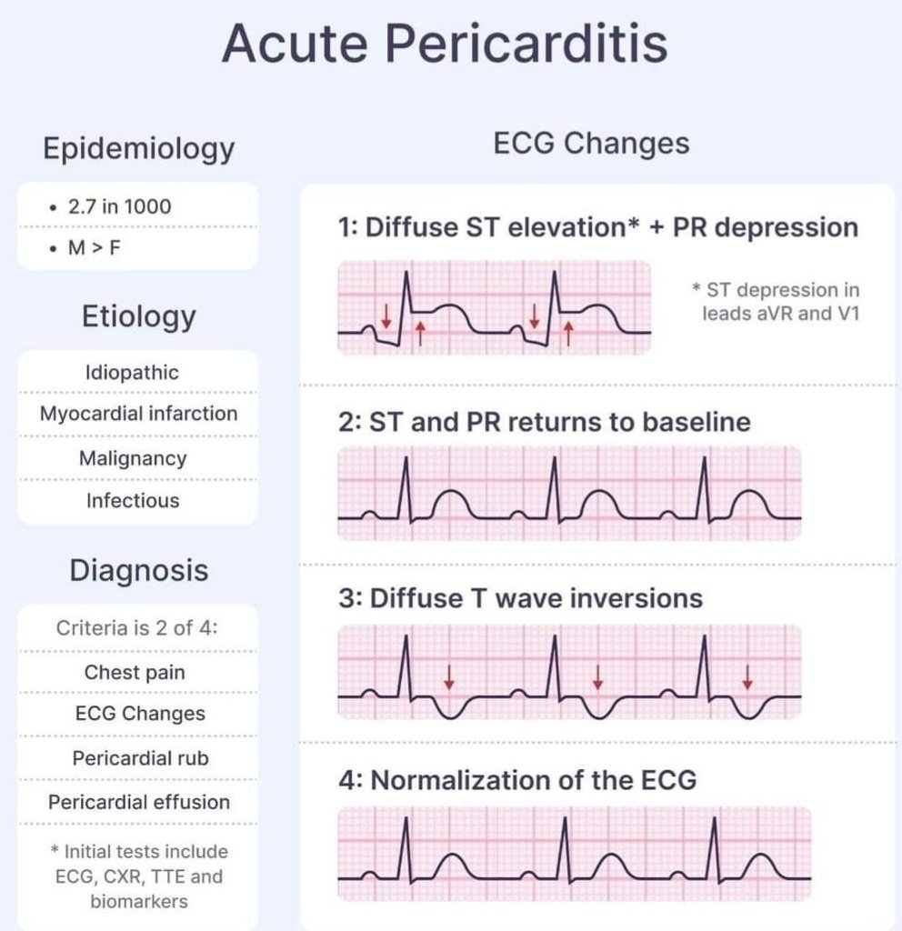 walinjom's tweet photo. Pericarditis: https://t.co/PmY8J6hKOO