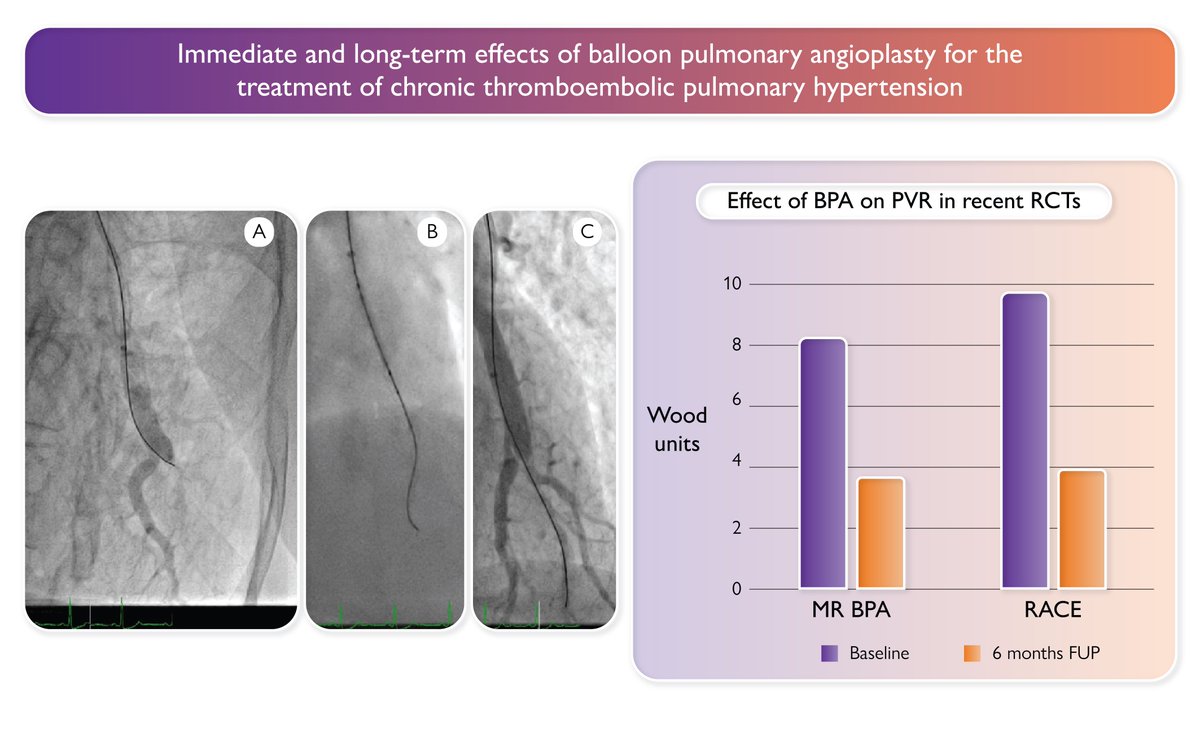 ehj_ed's tweet image. Immediate and long-term effect of balloon pulmonary angioplasty for treating chronic thromboembolic pulmonary hypertension! 

#thromboembolic #angioplasty #pulmonary #hypertension @ESC_Journals @escardio 

academic.oup.com/eurheartj/adva…