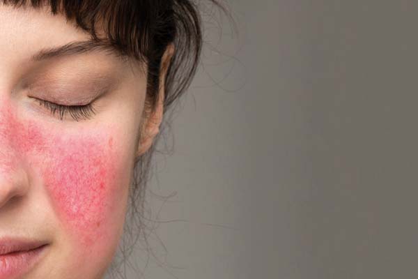 In Deutschland leiden geschätzt fünf Prozent der erwachsenen Bevölkerung an der chronischen #Hautkrankheit #Rosazea. Welche Ursachen hinter dieser #Hauterkrankung stecken, weiß man immer noch nicht genau. ow.ly/YN6A50P8fgk