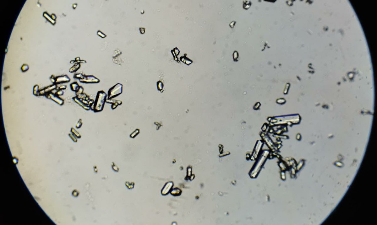 PEPJLHC's tweet photo. Magnesium ammonium phosphate crystals (struvite)
🔴Occurs when ammonia production is increased
🔴Alkaline urine PH>8
🔴Associated to infections like proteus or klebsiella ( due to urease-producing bacteria)
#UrinarySediment #NefroGea https://t.co/OSqLqu7fGb