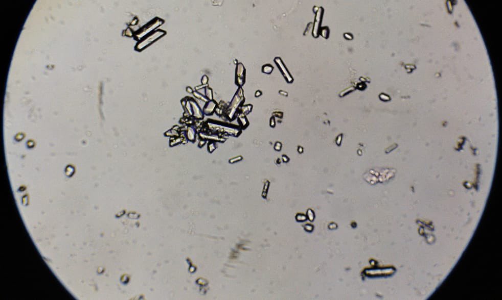 PEPJLHC's tweet photo. Magnesium ammonium phosphate crystals (struvite)
🔴Occurs when ammonia production is increased
🔴Alkaline urine PH>8
🔴Associated to infections like proteus or klebsiella ( due to urease-producing bacteria)
#UrinarySediment #NefroGea https://t.co/OSqLqu7fGb