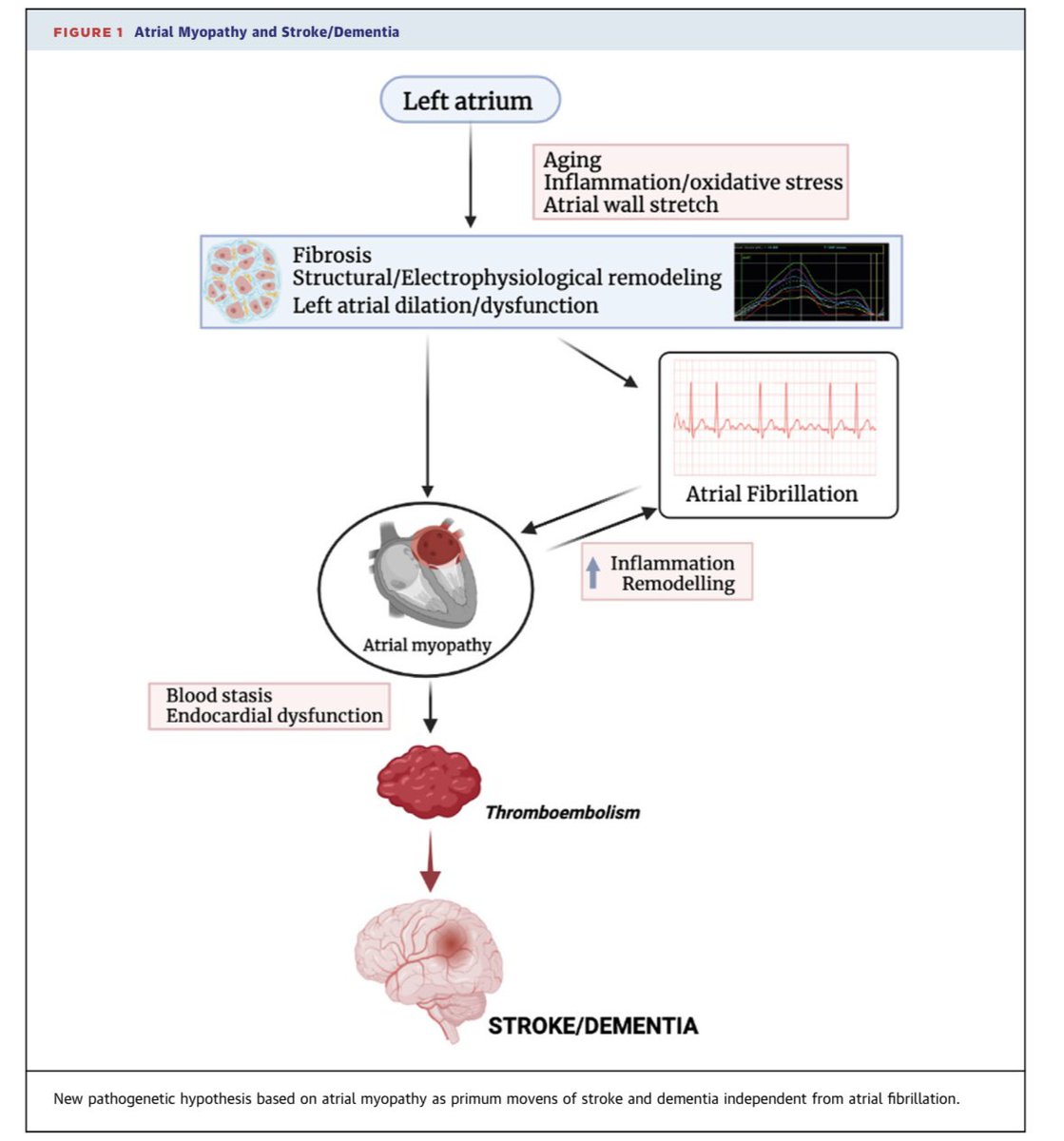Maria Concetta Pastore (@mc_pastore) on Twitter photo What if it is #atrial myopathy 🫀 the primary cause of #stroke and #dementia 🧠 , with or without #atrialfibrillation?
Read more in our #editorial comment just published in JACC: Advances 📄 #openaccess 🔓
<a href="/JACCJournals/">JACC Journals</a> <a href="/Matte_Cameli/">Matteo Cameli, MD, PhD</a> <a href="/CardiouniSiena/">CardioUni Siena</a>
➡️sciencedirect.com/science/articl… What if it is #atrial myopathy 🫀 the primary cause of #stroke and #dementia 🧠 , with or without #atrialfibrillation?
Read more in our #editorial comment just published in JACC: Advances 📄 #openaccess 🔓
<a href="/JACCJournals/">JACC Journals</a> <a href="/Matte_Cameli/">Matteo Cameli, MD, PhD</a> <a href="/CardiouniSiena/">CardioUni Siena</a>
➡️sciencedirect.com/science/articl…