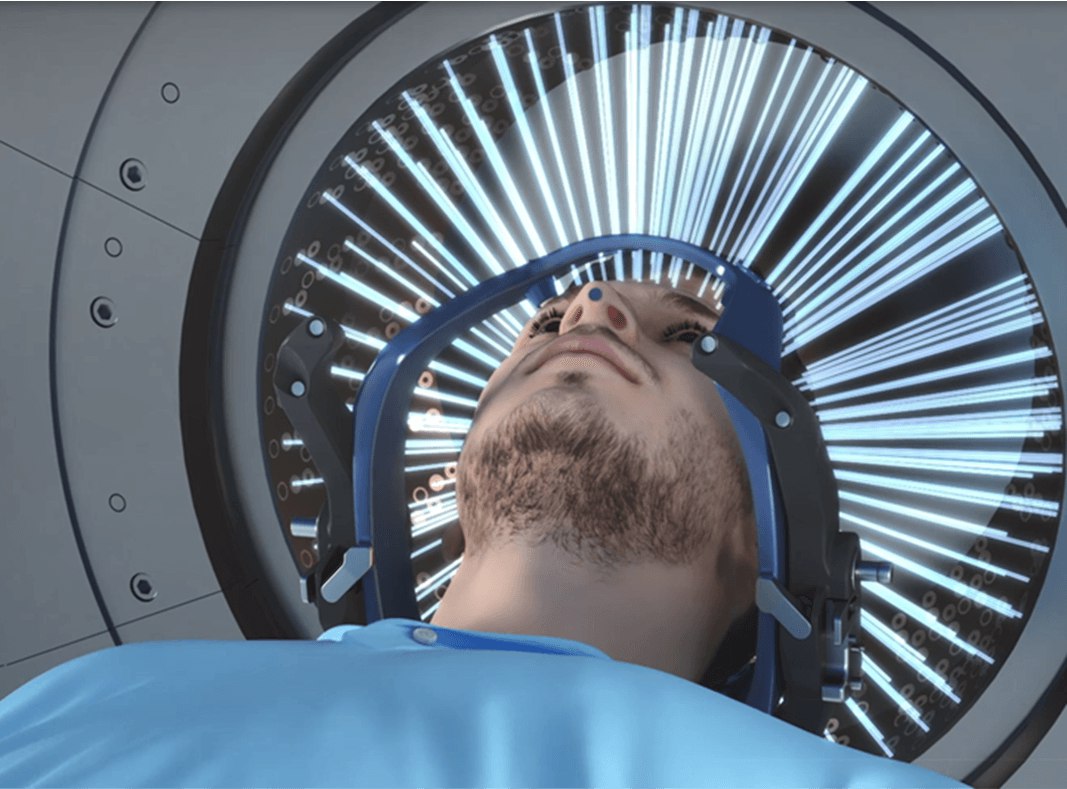 JNeurosurgical's tweet photo. Efficacy of whole-sellar gamma knife radiosurgery for magnetic resonance imaging-negative Cushing’s disease

https://t.co/5W4qctS3hd

#JNSS #neurosurgery #edizioni_minerva_medica #surgeon #neurosurgeon #gammaknife #cushing #cushingdisease https://t.co/tCkWs6Y4JO