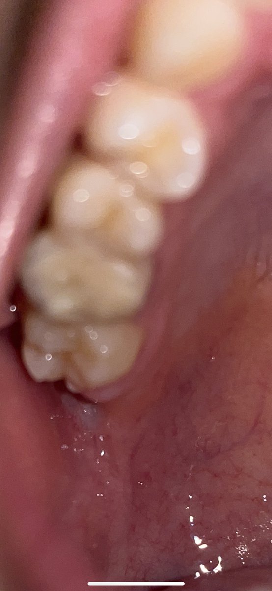 ボケてるけど根っ子の洗浄して仮詰め
ちょっと痛かった🥲