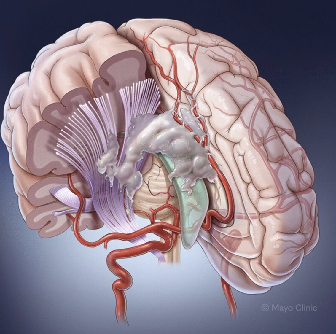 paosmeade's tweet photo. Human GBM cells migrating in the human brain 🧠 check out our latest contribution to the literature at @JNeurooncol, where we demonstrate the GBM migration dynamics and interaction with relevant ECM & microenvironment in a human organotypic model. This will allow us to study GBM invasion mechanisms, cell-ECM interactions, drug effects on cell invasion, intercellular molecular trafficking, and many other aspects of brain tumor biology and treatment. #Neurosurgery #GBMResearch @DoctorQMd @DoctorQMDLab @RavinRea @HugoGuerreroLab @kchaichanamd @emilynorton295 @TitoVivasB @MayoClinicNeuro @MayoClinic @NIH