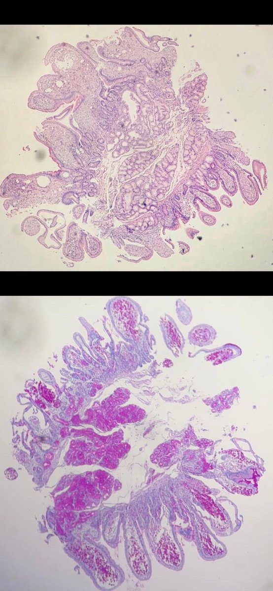 missnzzhat's tweet photo. 🧼 Foamy macrophages
🫧 Dilated lymphatic vessels 
🫧 Focal acute inflammation 
🔴 PAS , PASD 🔵 AFB , GMS
🦠 Brings to mind (Tropheryma whipplei)
#gipath #pathtwitter #Tropheryma https://t.co/xf4mNSBaZJ