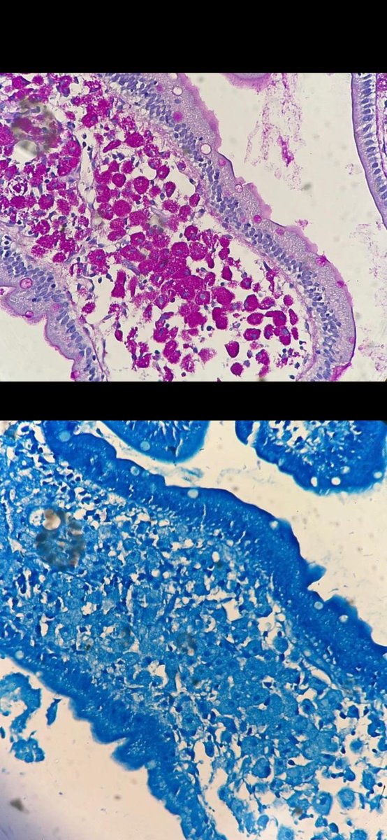 missnzzhat's tweet photo. 🧼 Foamy macrophages
🫧 Dilated lymphatic vessels 
🫧 Focal acute inflammation 
🔴 PAS , PASD 🔵 AFB , GMS
🦠 Brings to mind (Tropheryma whipplei)
#gipath #pathtwitter #Tropheryma https://t.co/xf4mNSBaZJ